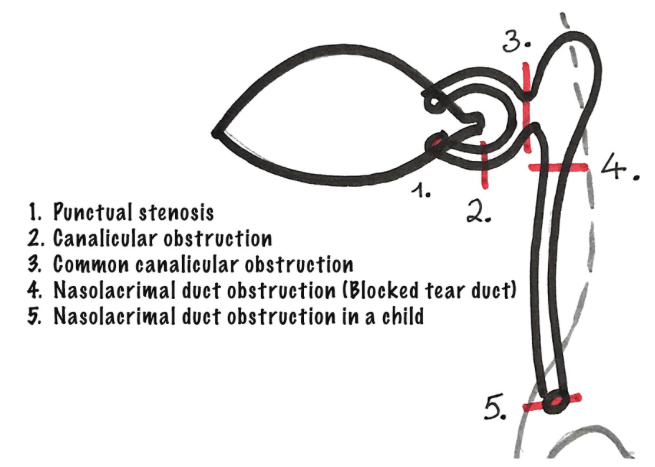 <p>1) Punctual Stenosis</p><p></p><p>2) <strong>Canalicular obstruction</strong> → inferior or superior</p><p></p><p>3) Common canalicular obstruction</p><p></p><p>4) Nasolacrimal duct obstruction</p><p></p><p>5) <strong>Congenital nasolacrimal duct obstruction</strong></p><p></p>