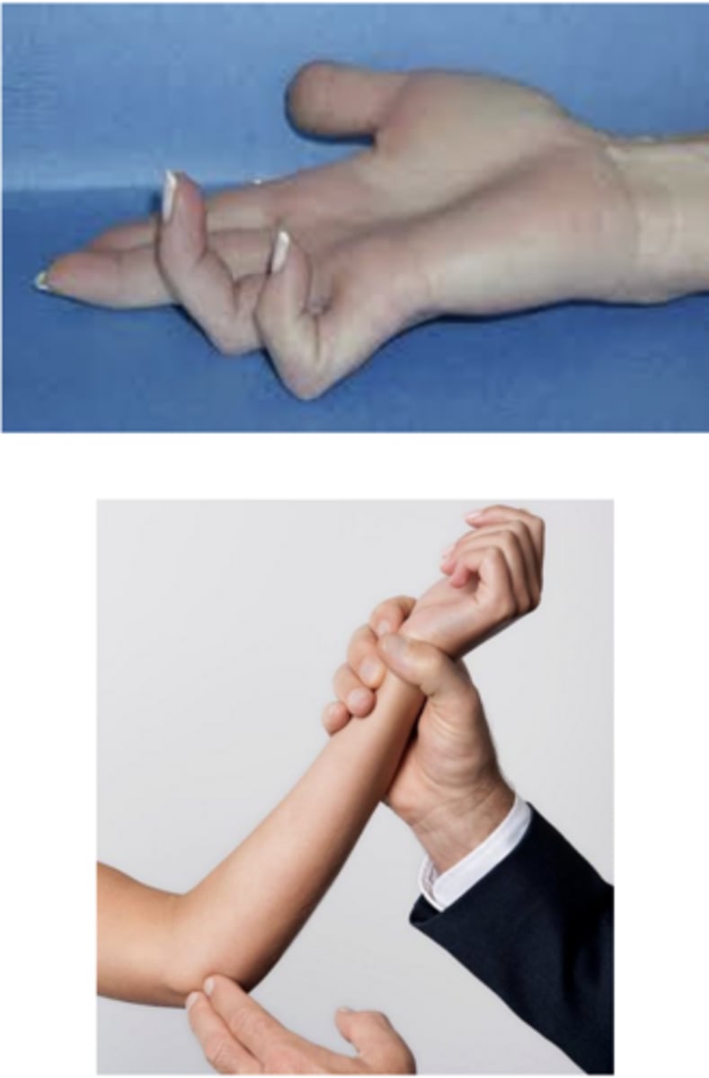 <p>intrinsic muscle atrophy, claw hand, decreased sensation over ulnar nerve distribution, motor weakness, positive tinel sign at elbow</p>