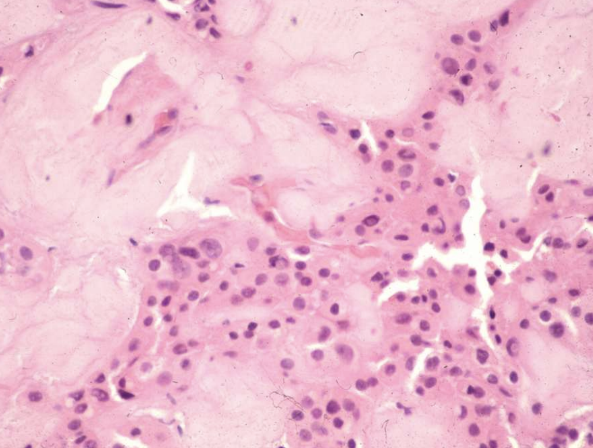 <p>• Islands, strands, or sheets of epithelial cells in fibrous stroma</p><p>• Calcifications form concentric Liesegang rings</p>