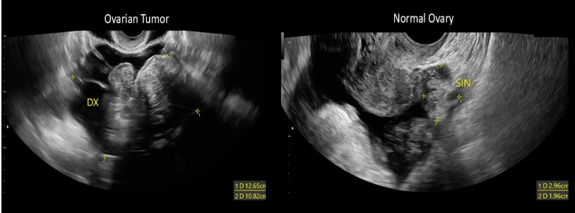 <p>a) fibroma</p>