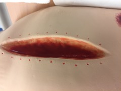 -Large wound with considerable tissue loss
-Natural healing by formation of granulation tissue
-Healing takes longer and results in more scarring
ex. pressure ulcer

Would occur when a wound that cannot be stiched causes a large amount of tissue loss.