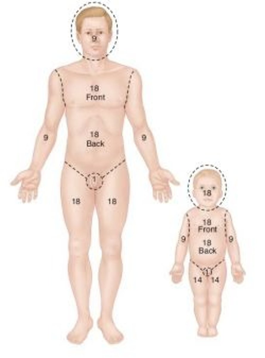 <p>a method used in calculating body surface area affected by burns</p>