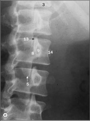 <p>The structure designated as # 5 is the:</p><p>a. Superior articular process (facet)</p><p>b. Inferior articular process (facet)</p><p>c. Pars intucularis</p><p>d. Pedicle</p><p>e. Transverse process of second lumbar vertebravertebra</p><p>f. lamina</p><p></p>