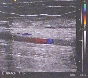 <p>Describe how this image could be optimized for better color flow in the artery. List at least 2 settings that could be adjusted</p>