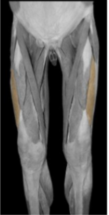 <p>Vastus Lateralis </p>