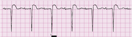 Rate: can occur at any rate

Regularity: depends on underlying rhythm

P waves: upright, matching, 1:1

PR: prolonged (> 0.20 secs)

QRS: < 0.12 secs
