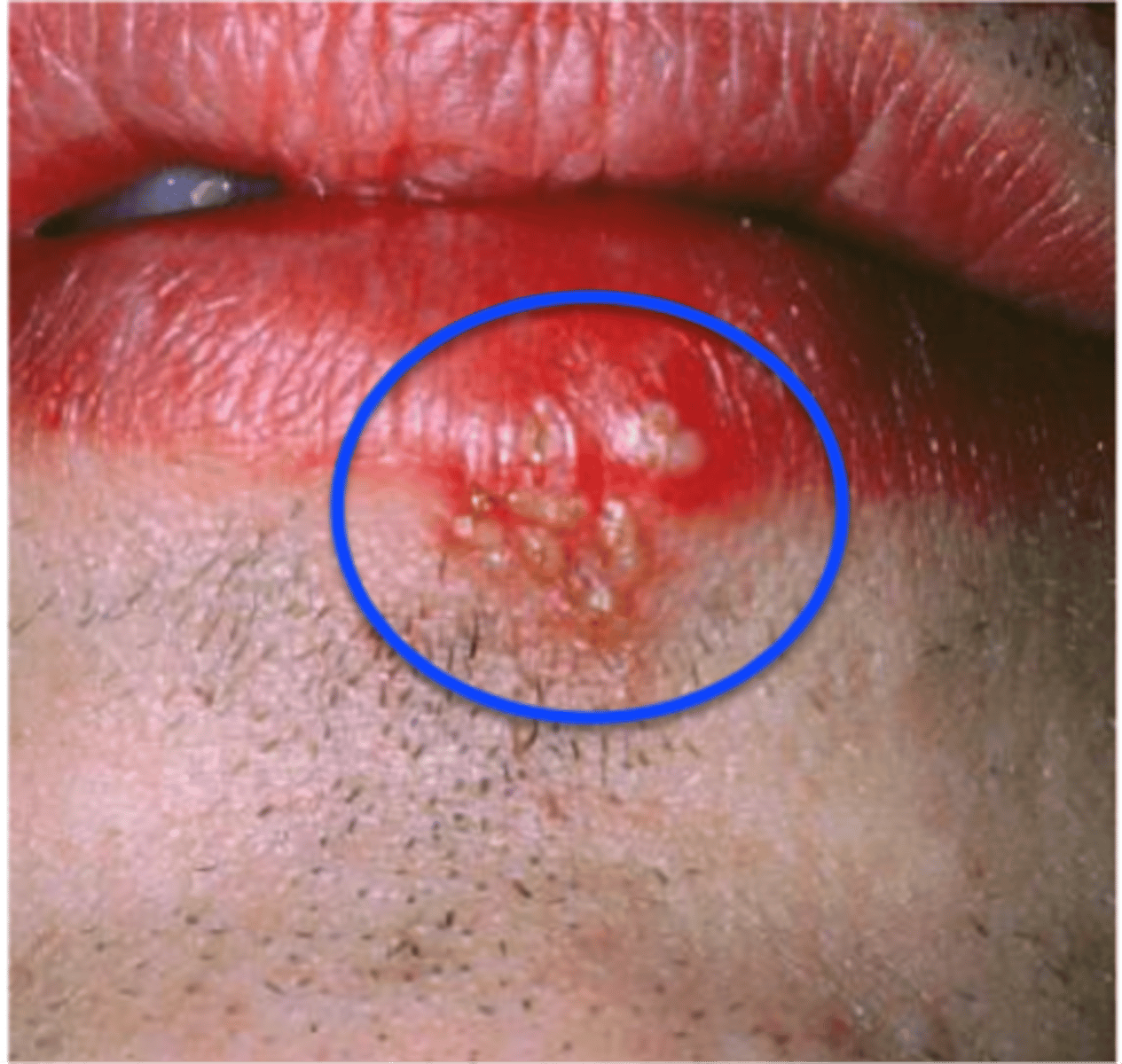 <p>Herpes Labialis</p>