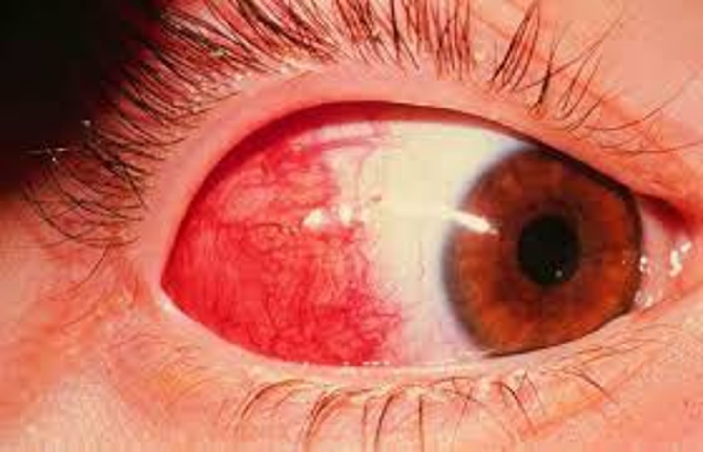 <p>Inflammation Sclera</p>