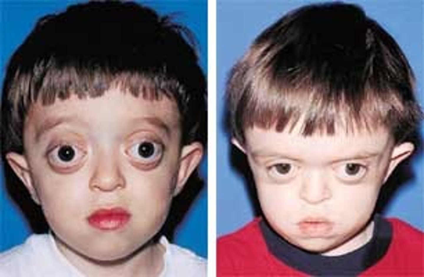 <p>Protruding Eyeballs</p>