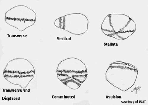 <p>What are patella fracture types?</p>