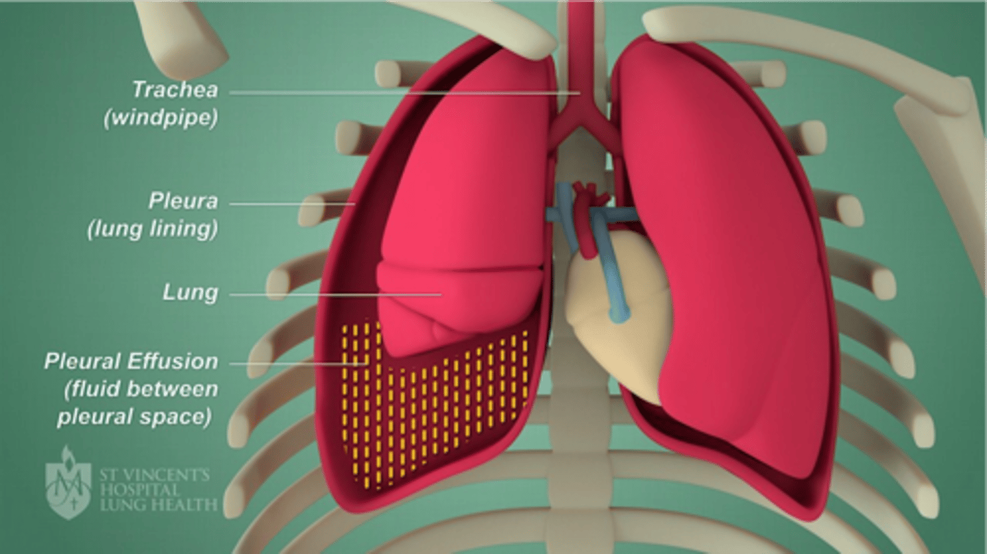 <p>Fluid between the pleural space. A chest tube can help fix this and drain the fluid</p>