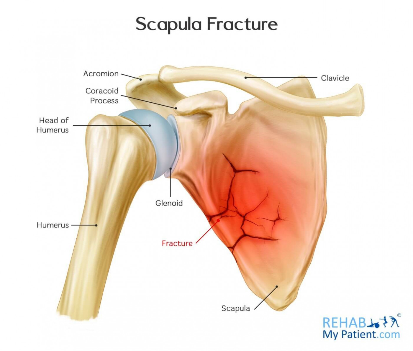 <p>fractures don’t usually require surgery due to support of multiple muscles that hold scapula in place </p>