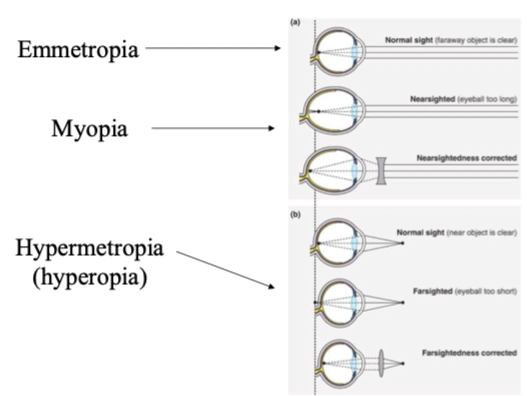 <ul><li><p>normal vision</p></li><li><p>Eyeball too long, near sighted.  Far object focus is infront of retina. <strong>Concave lens pushes focus </strong>(decrease convergence)<strong>backward onto retina. </strong>Near sight is fine. </p></li><li><p>Eyeball too short, far sighted. Far sight: is fine because of accomodation but <strong>convex lens causes muscles to relax. </strong>Near sight: has insufficient accomodation so <strong>convex lens</strong> brings the focus forward <strong>(increase convergence)</strong>. </p></li></ul><p></p>