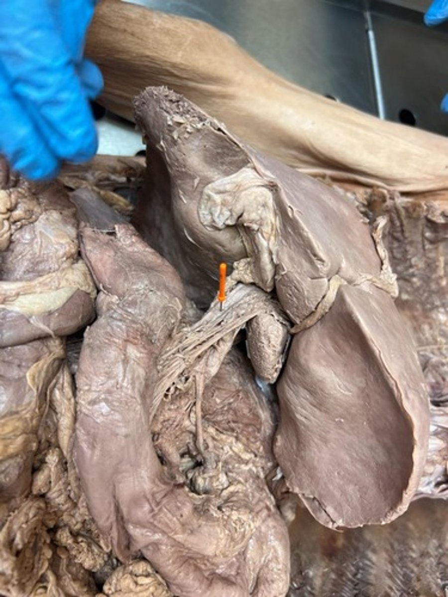 <p>hepatic portal vain</p>