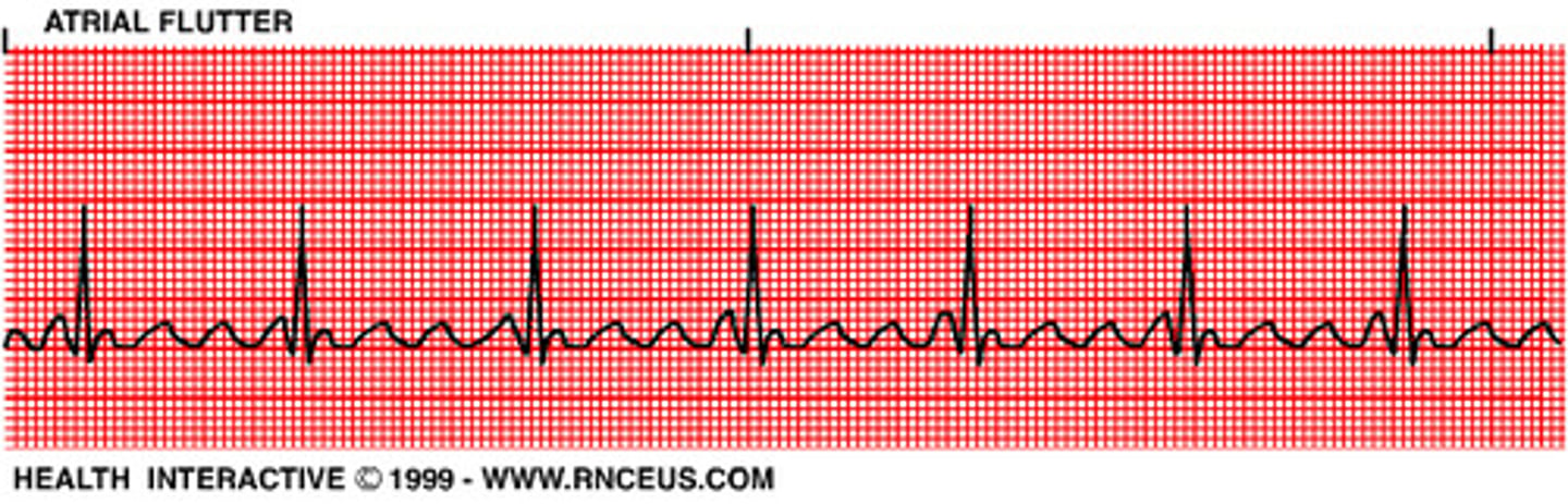 <p>usually has an atrial rate around 250 to 350 bpm with a sawtooth pattern.</p><p>The ventricular response depends on AV conduction; examples may be described as 2:1, 3:1, etc.</p><p>PR interval: usually not measurable.</p><p>QRS: narrow.</p><p>Treatment includes rate control, antiarrhythmics, or synchronized cardioversion.</p>