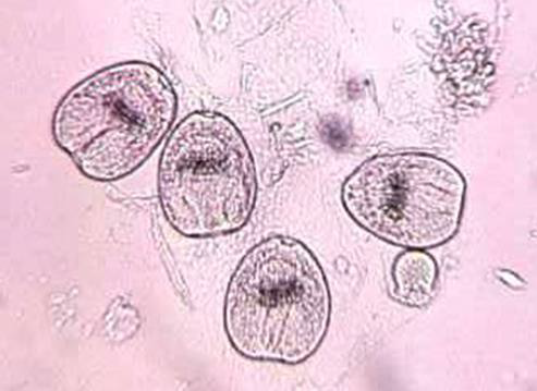 <p>Hydatid sand</p><p>Detached scolices, brood capsules, and daughter cysts that fall in hydatid fluid</p><p>Fluid aspirated from surgically removed cyst</p>