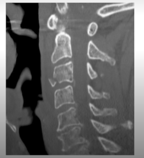 <p>What is the fracture seen in the image below and how is it caused? </p>