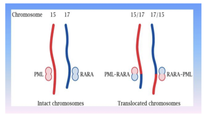 <p>En specifik typ av AML; translokalisation av t(15;17) leder till fusionsproteinet <strong>PML-RARa</strong> → en abberant receptor för retinolsyra.</p><p>Retinol är viktig för mognaden av myeloida celler men fusionsproteinet leder till en mognadsstörning. Ger akut <strong>koagulationspati</strong>. </p><p>Behandling är kurativ med <strong>ATRA</strong> (vitamin A derivat) som stimulerar mognaden till mogna granulocyter. Man ger även <strong>arsenik</strong> som inducerar apoptos hos promyeloida leukemiska celler. </p>