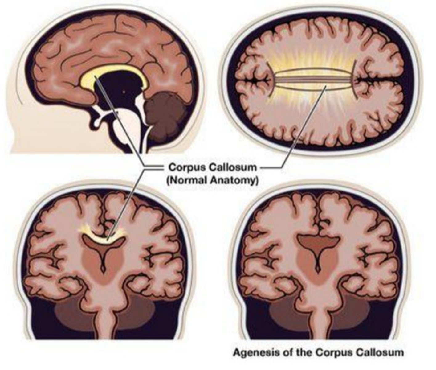 <p>the congenital absence of corpus callosum which may be partial or complete</p><p>IQ and language normal unless other anomalies are present</p><p>minimal disconnection syndrome compared to adult split-brain cases → neuroplasticity allows alternative cross-hemispheric pathways (e.g., anterior commissure)</p><p>only tasks needing fast, complex interhemispheric integration show impairment</p>