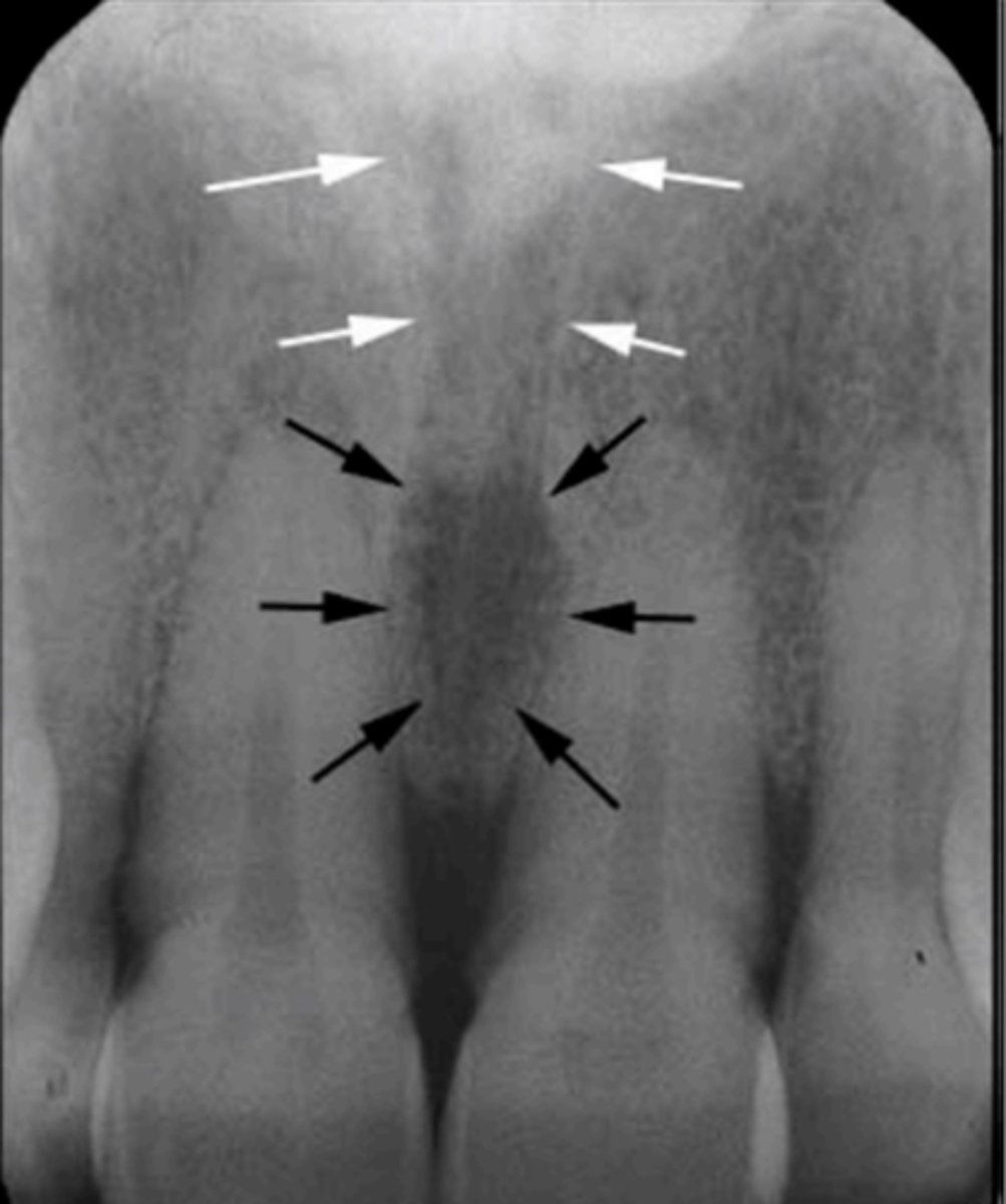 <p>Identify the straight, radiopaque lines indicated by the white arrows.</p>