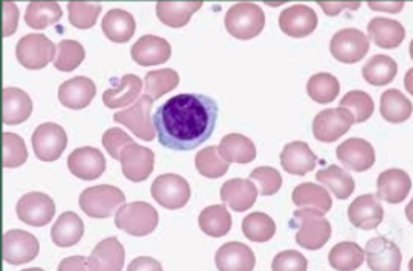 <p>an abnormally reduced number of lymphocytes</p>