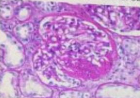 <p>Patron de afectacion glomerular observado en la siguiente microfotografia de tejido con PAS:</p>