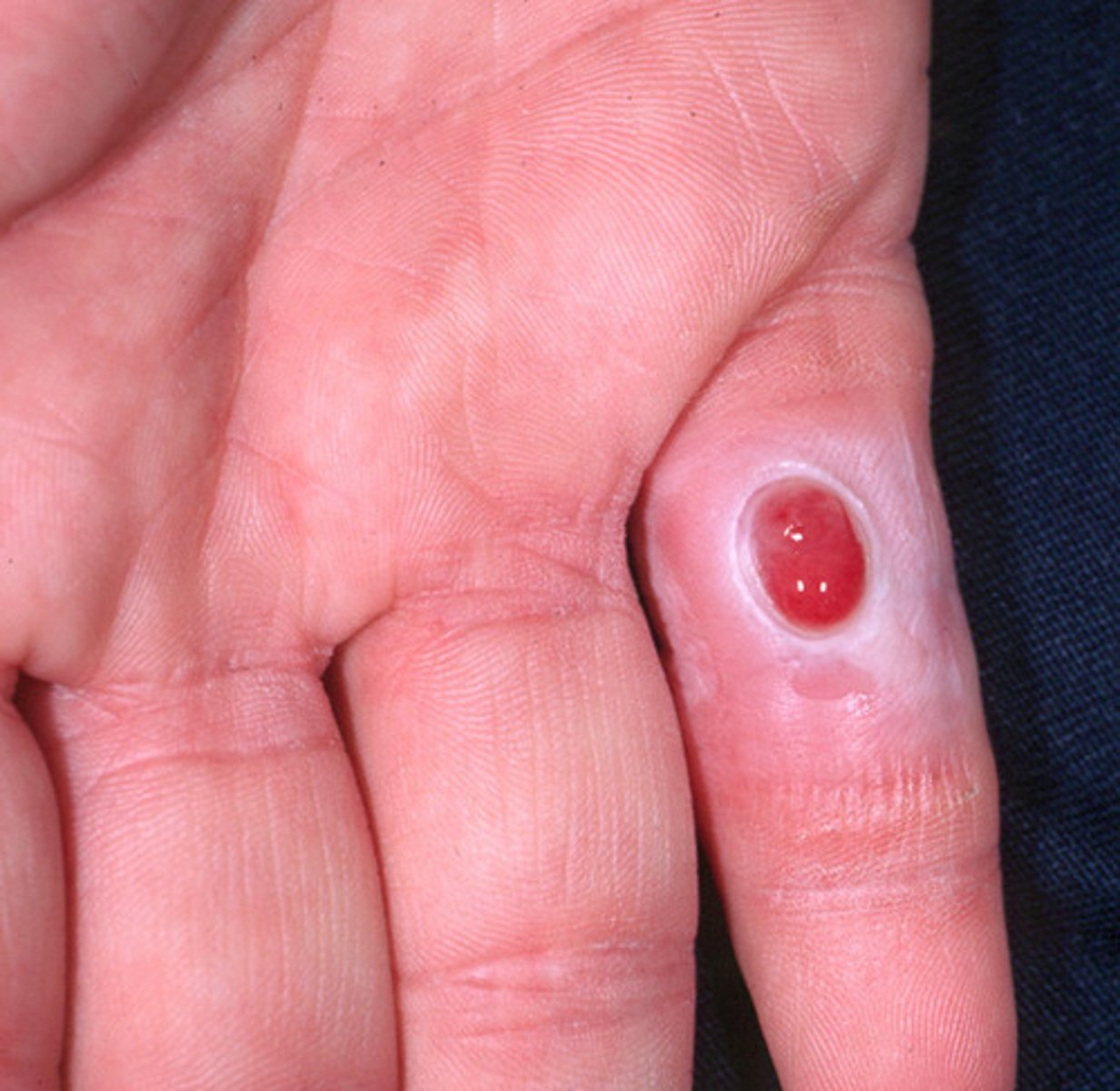 <p>A small area of inflammation (contains epithelioid cells)</p>