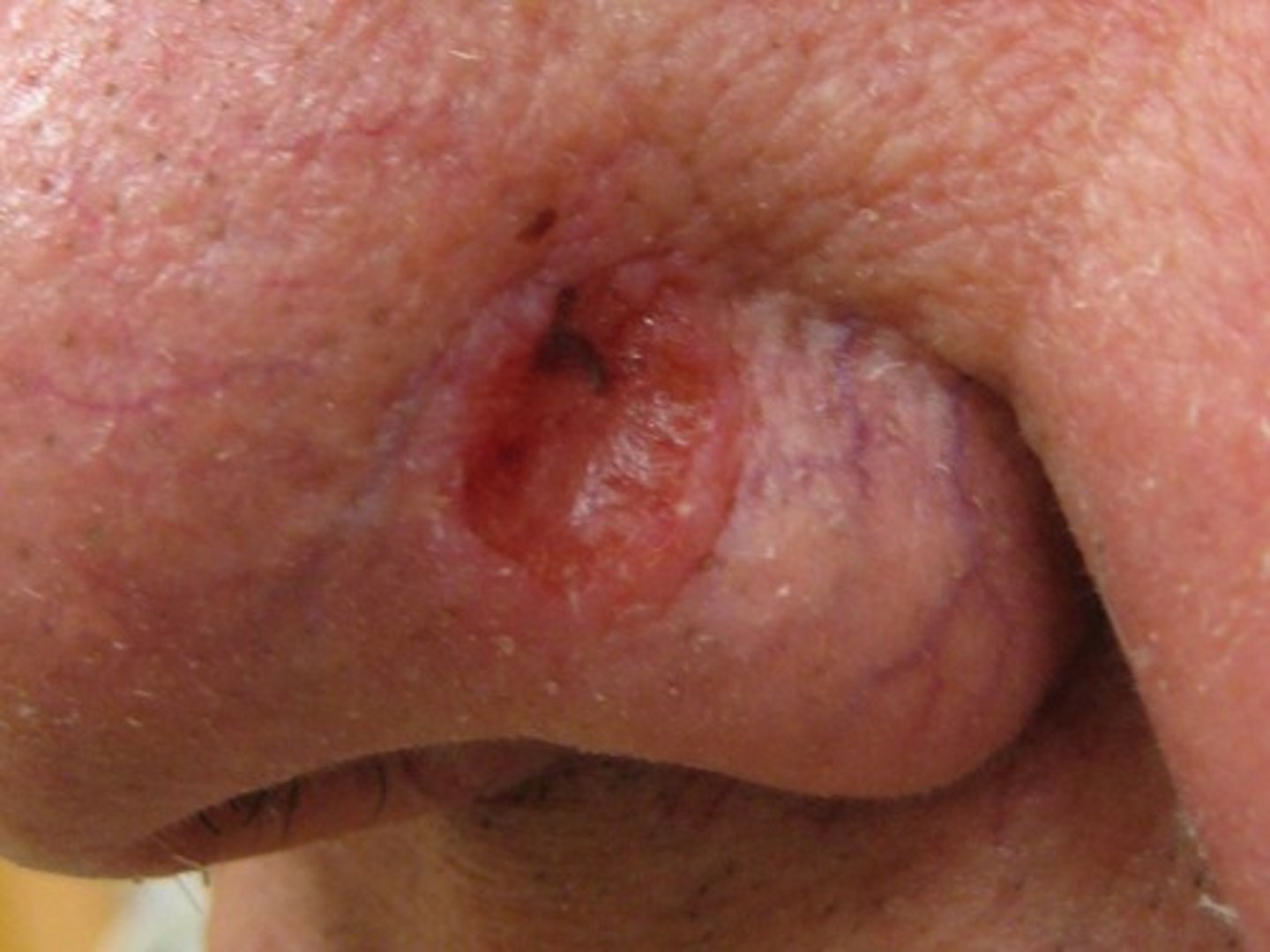 <p>Hoe heet dit klinisch beeld</p>