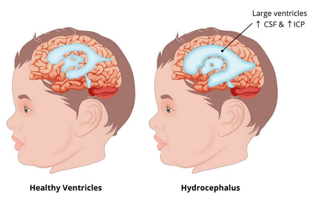 ● Increased accumulation of cerebrospinal fluid  

● Increases ICP 

● Causes: 

○ Tumor 

○ Hemorrhage 

○ Infection 

○ Congenital