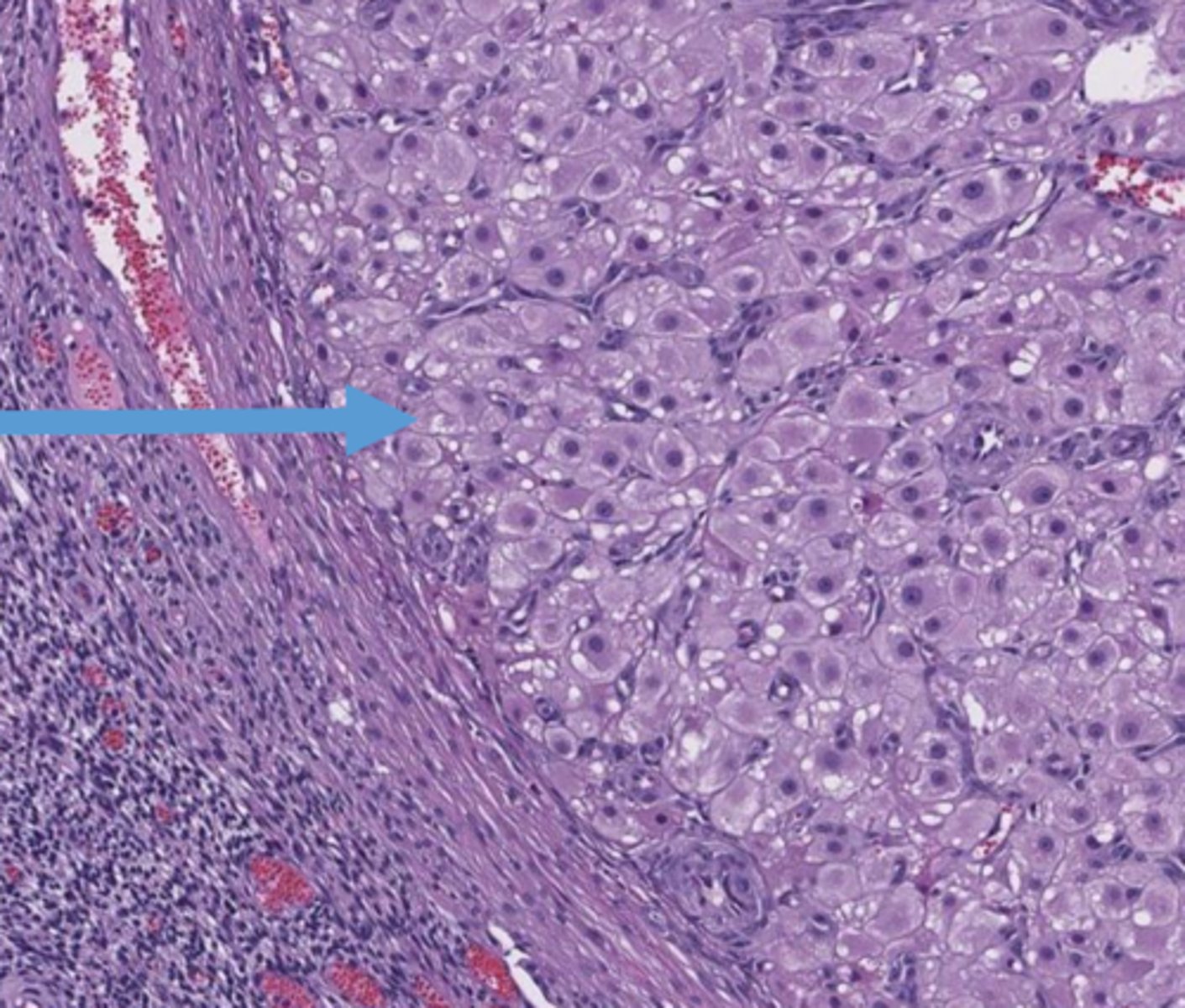 <p>these cells with vacuolated, eosinophilic cytoplasm</p>