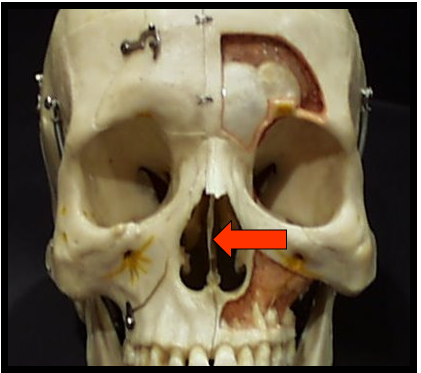 <p><span>Vertical bony wall or partition that divides the nasal cavity into the right and left nasal fossa</span></p>