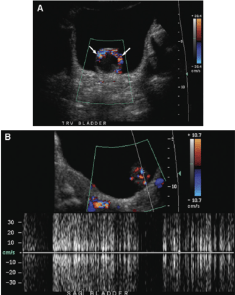 <p>Occurs at the margin of a strong, smooth, specular reflector - stones, bones, catheters, foley balloons, etc.</p><p>Displayed as persistent color along reflector's edge</p><p>More common with power Doppler</p>