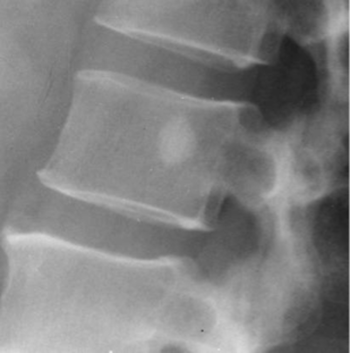 <p>- Any age</p><p>- Adults &gt; children</p><p>- Asymptomatic</p><p>- Usually solitary</p><p>- Any bone (except skull)</p>