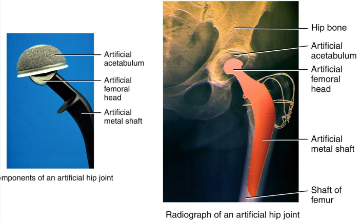 <p>It is rough because it allows bone to grow into it and cement it in place</p>