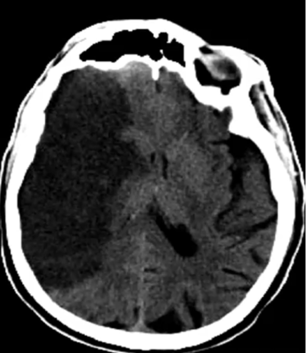 <p>What vascular area is affected by this stroke?</p>