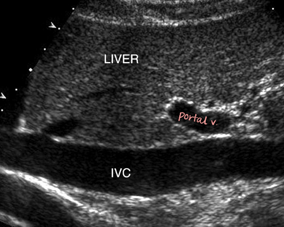 <ul><li><p>retroperitoneal</p></li><li><p>travels superiorly from the convergence of common iliac veins</p></li><li><p>to right of spine and AO</p></li><li><p><mark data-color="yellow" style="background-color: yellow; color: inherit;">posterior to portal vein</mark>, intestine, liver </p></li><li><p>medial to RK</p></li></ul><p></p>