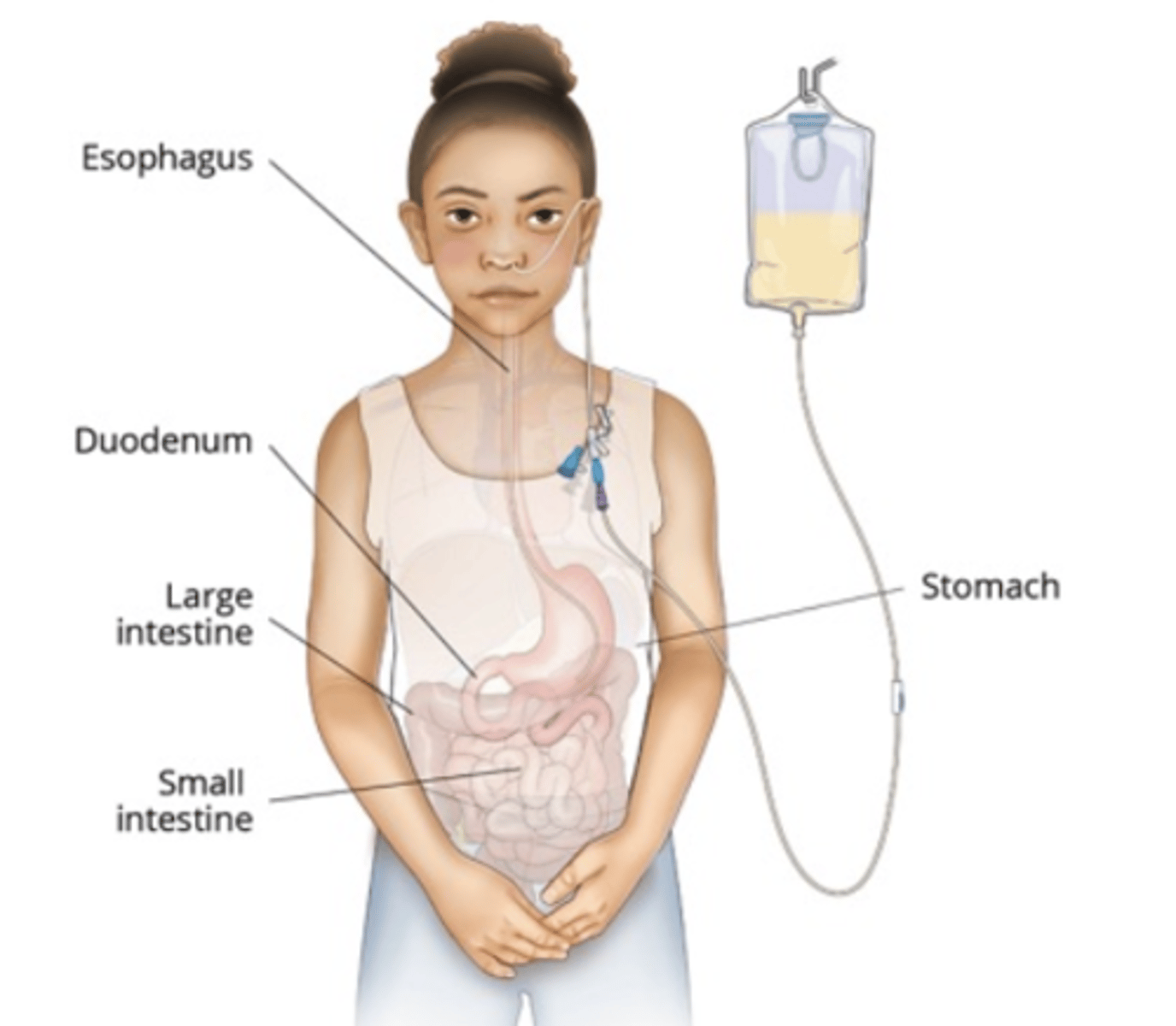 <p>- nutrition: enteral feeds (protein demands at 50% above normal (normal: 1g/kg))</p><p>- prevent infection (sterile dressings, isolation)</p><p>- eschar removal (excision, escharotomy) => excision decreases hypermetabolic state; wound grafting ASAP</p><p>- manage long term hormonal imbalance (exhausted by hypermetabolic response) (eg. growth hormone, testosterone)</p>