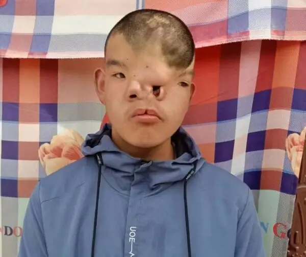 <p>midline facial clefts </p>