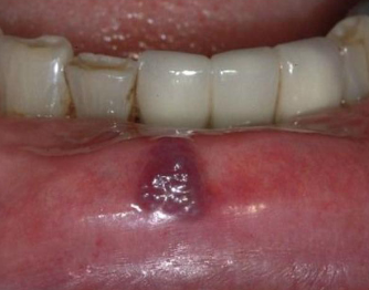 <p>red/blue, firm, blanches with diascopy </p>