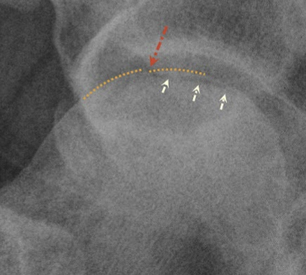 <ul><li><p>MRI, CT and Nuclear scans are better at detecting early stages</p></li><li><p><strong>Crescent sign </strong>= radiolucent subcortical band representing a fracture line</p></li><li><p>Later Stages = flat femoral head, combo of sclerotic (dense) and lytic (translucent) regions</p></li></ul><p></p>