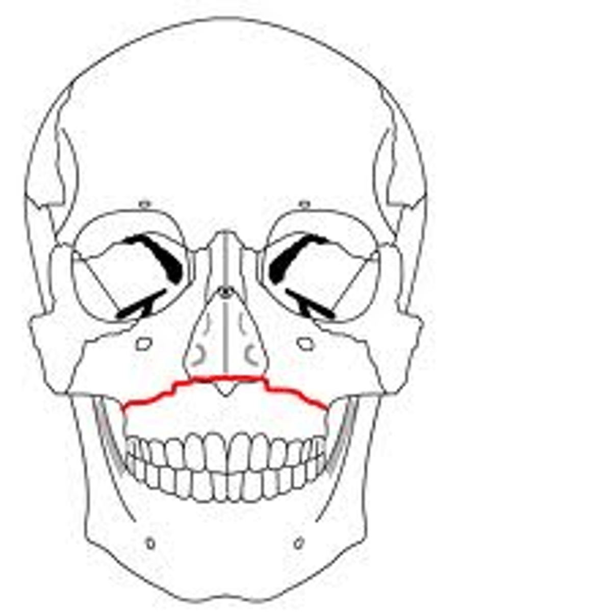 <p>Fracture that proceeds through the maxillary bone, at the base of the nasal bones</p>