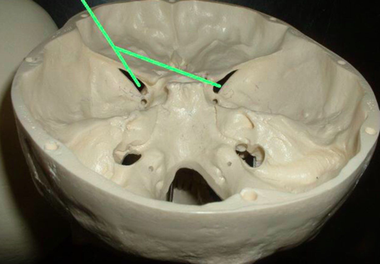 <p>What structures/features make up the superior orbital fissure?</p>