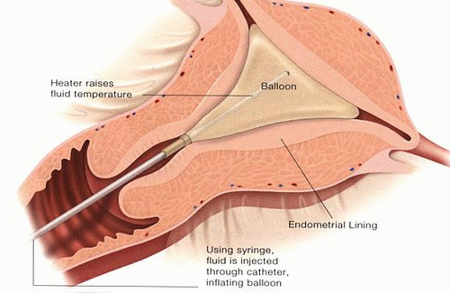 <p>-a balloon is inserted into the uterus</p><p>-balloon is filled with an isotonic saline solution</p><p>-the solution is heated to 87 degrees for 8 minutes</p>