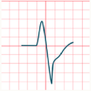 <ul><li><p>likely to have originated in the ventricles</p></li><li><p>if electrical activity is initiated w/in ventricles and travels by an abnormal path across the ventricular muscle, depolarisation occurs at a slower rate</p></li></ul><p></p>