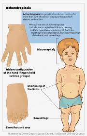 <p>1/10,000 live birth </p><p>Short limbs </p><p>Normal sized head, body and intelligence</p><p>Due to mutation <strong>in FGFR3 gene (inhibition of bone growth) - mutation in the transmembrane domain</strong></p><p>Mutation causes the receptor to signal in the absence of ligand</p>