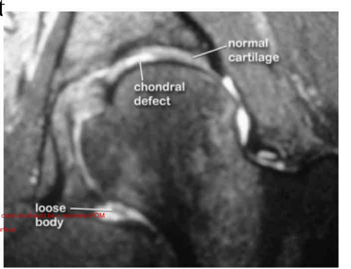<p>Chondral Defect: MOI</p><ul><li><p>What are the 6 main MOI for Chondral Defect?</p></li></ul><p></p><p></p>