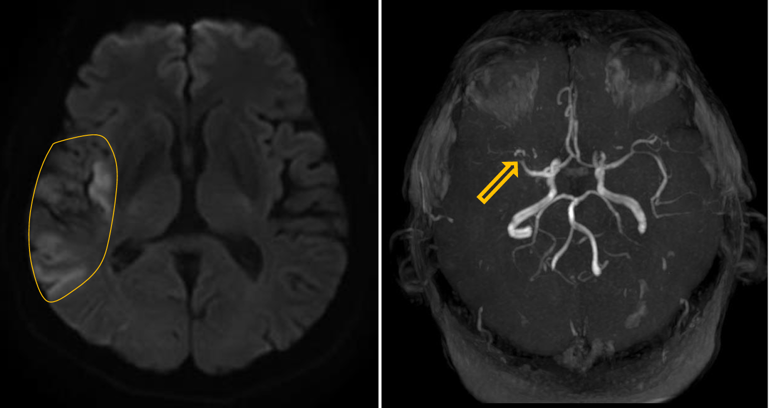 <p>Patient history: leftsidedhemihypesthesia, visualneglect(ignores things on the left side) for a couple of hours </p><p>Modality: DWI MRI (left) and 3D TOF (time-of-flight) angiography (right); noncontrast sequence </p><p>Region: brain, axial view </p><p>Radiologic sign: significant hyperintensity (representing restricted diffusion) in the right parietal lobe with concomitant abrupt filling defect at the right middle cerebral artery </p><p>Diagnosis: large acute infarction due to acute thrombosis of the right middle cerebral artery</p>