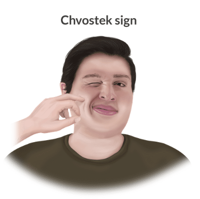<p>Tapping on the angle of the jaw leads to facial contraction on the ipsilateral side (sign of hypocalcemia).</p>
