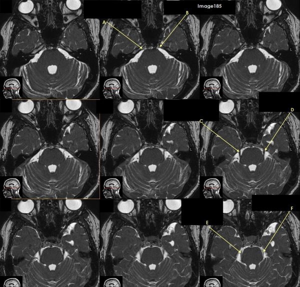 <p>Letter F in Image 185 is pointing to which cranial nerve?</p>