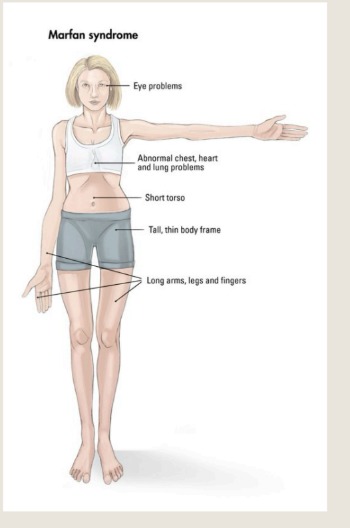 <p>Marfan syndrome is caused by a defect in</p><p>the gene that enables your body to produce</p><p>a protein that helps give connective tissue</p><p>its elasticity and strength</p><p>Most people with Marfan syndrome inherit</p><p>the abnormal gene from a parent who has</p><p>the disorder</p>